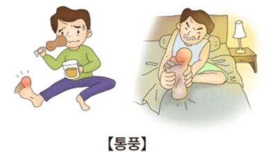 통풍이미지