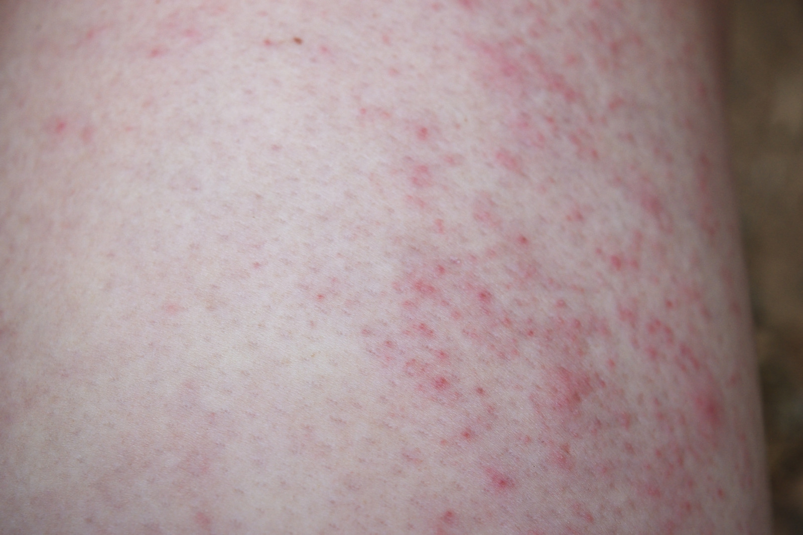 땀띠(한진, Miliaria) 완전정리: 여름철 필수 피부 관리법