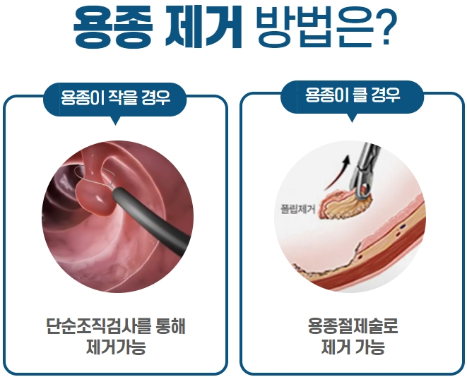 대장용종제거
