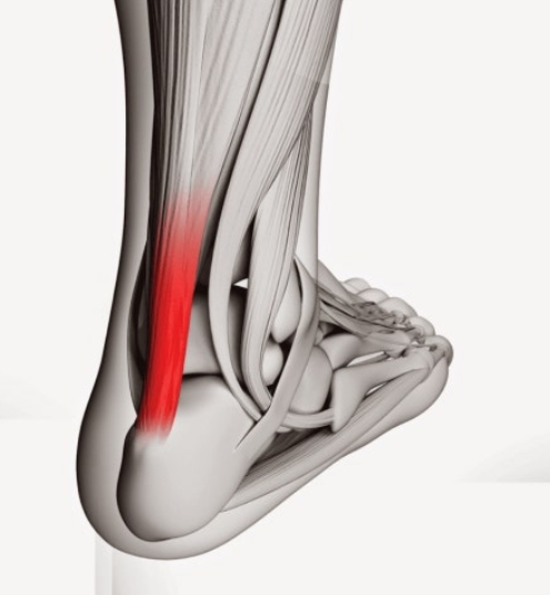 중증 아킬레스 건염의 부작용