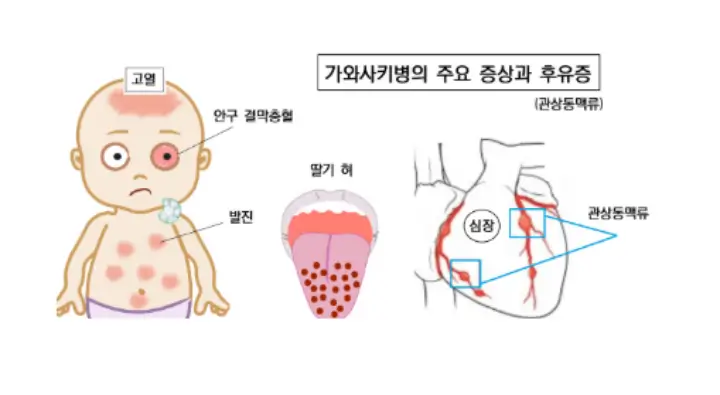 가와사키병-증상