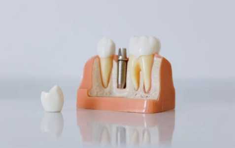 강원 고성군 치과 임플란트 가격 종류 비교