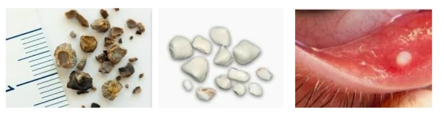 요로결석,담석,결막결석