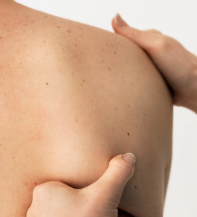 피부암 초기증상 15