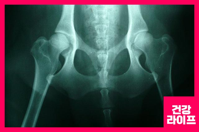 고관절 통증 증상 8가지