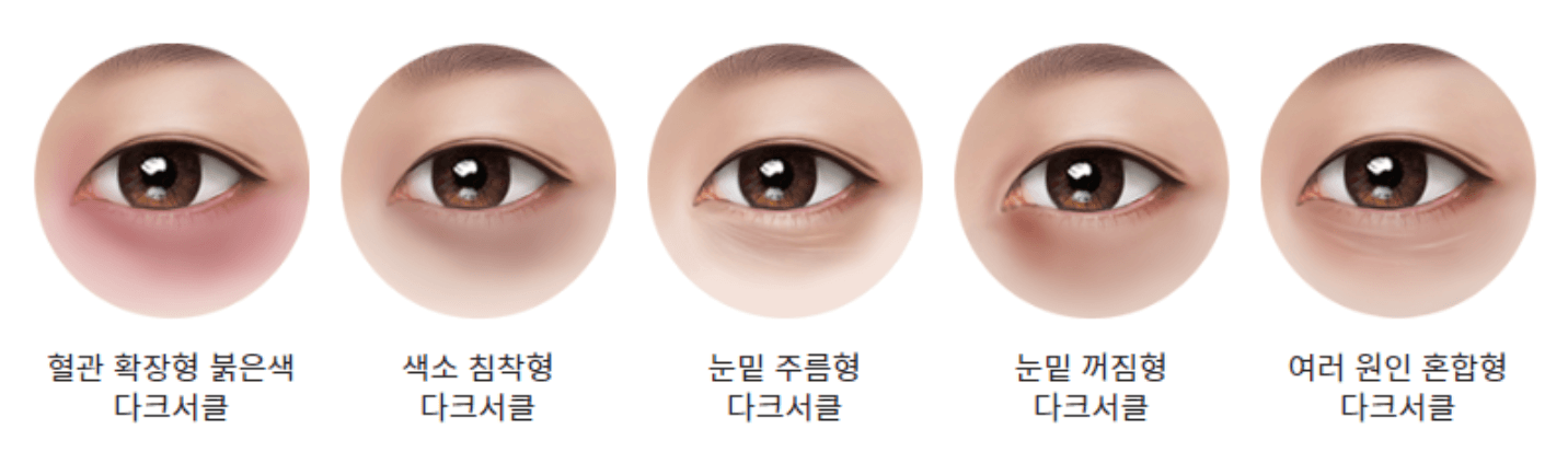 다크서클 원인