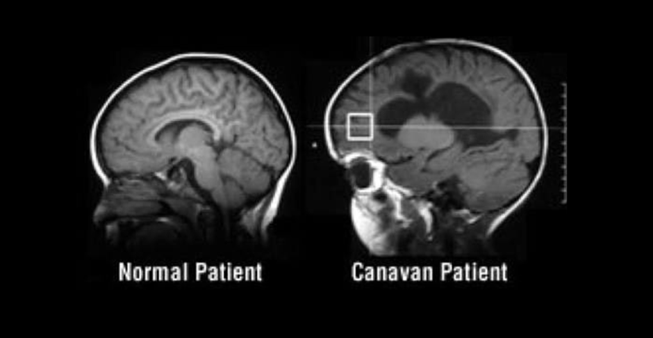 카나반병을 가진 환자와 정상인의 뇌