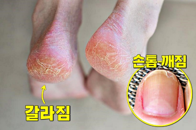 피부 갈라짐 손톱 부러짐 단백질 부족 증상, 단백질 부족을 알리는 우리 몸의 7가지 신호, 건강 팁줌 매일꿀정보