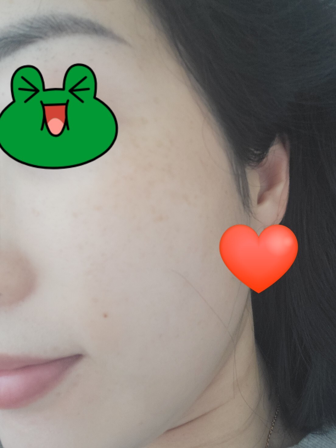 흑자레이저 후기