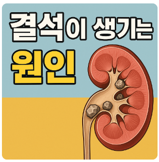 요로결석