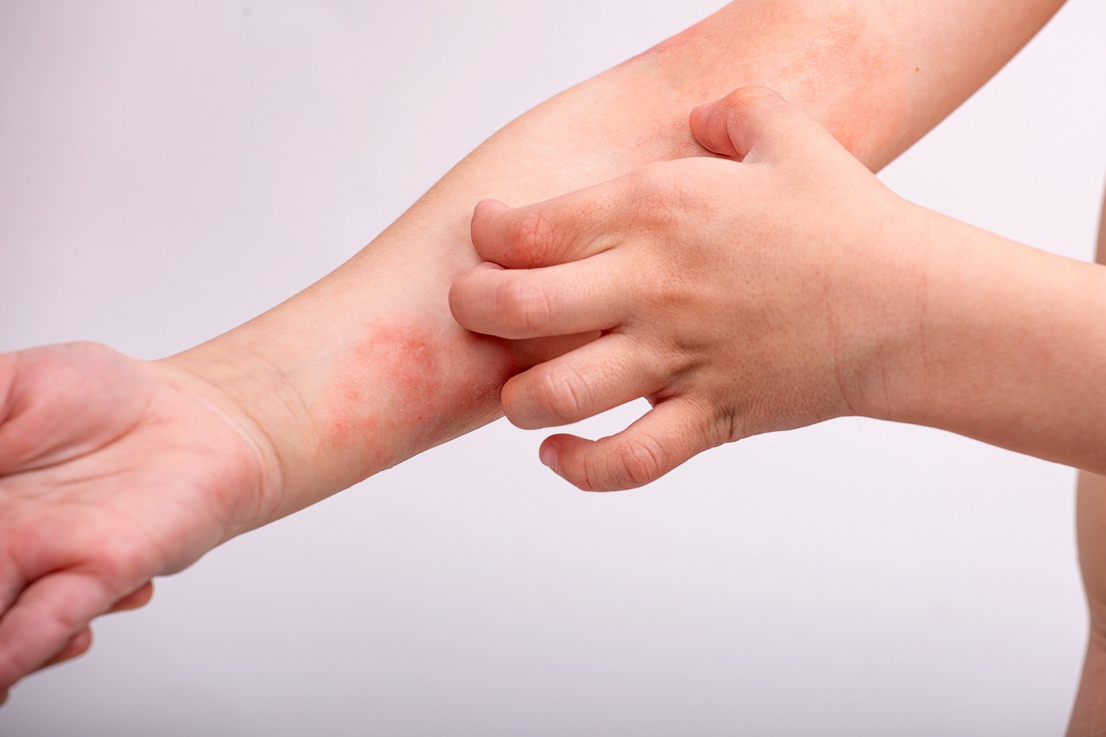 아토피 피부염(Atopic Dermatitis): 증상, 원인 및 치료 방법