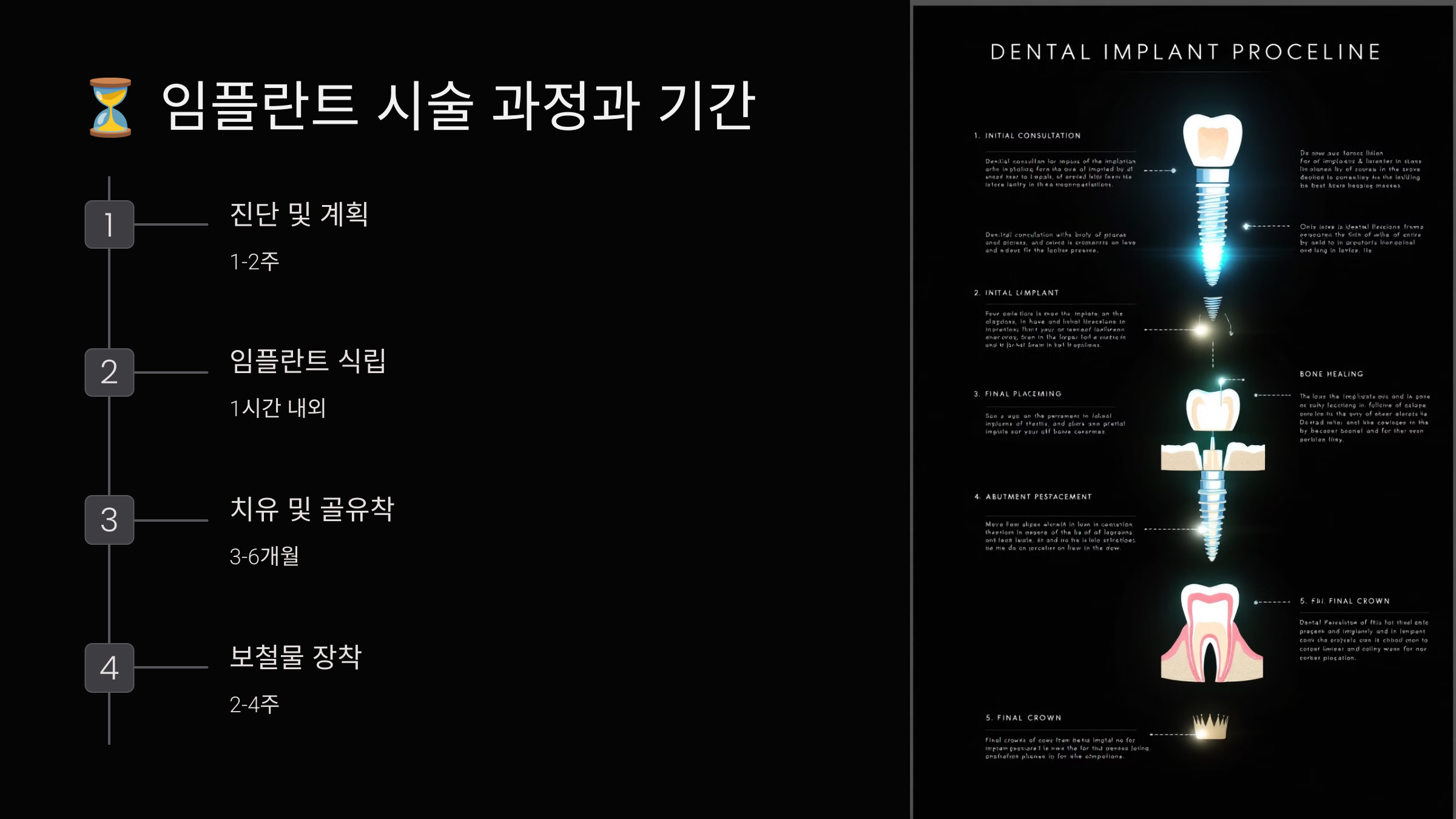 임플란트 시술 과정과 기간