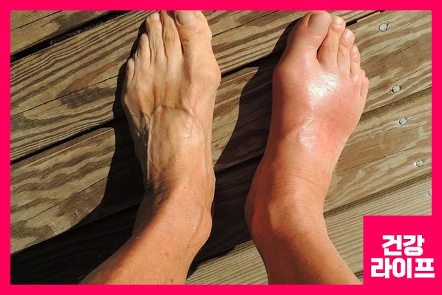 발목 염좌로 인한 통증은 부종이 생긴다