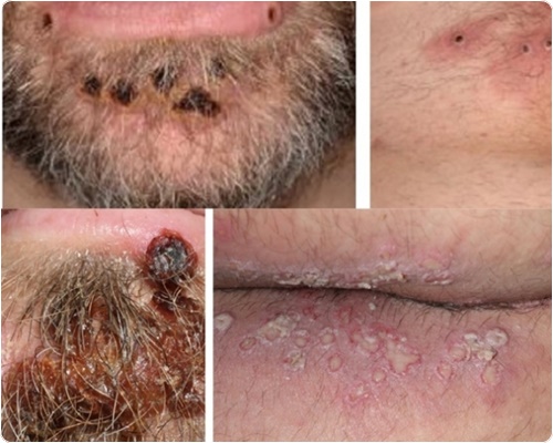 엠폭스 증상 및 원인