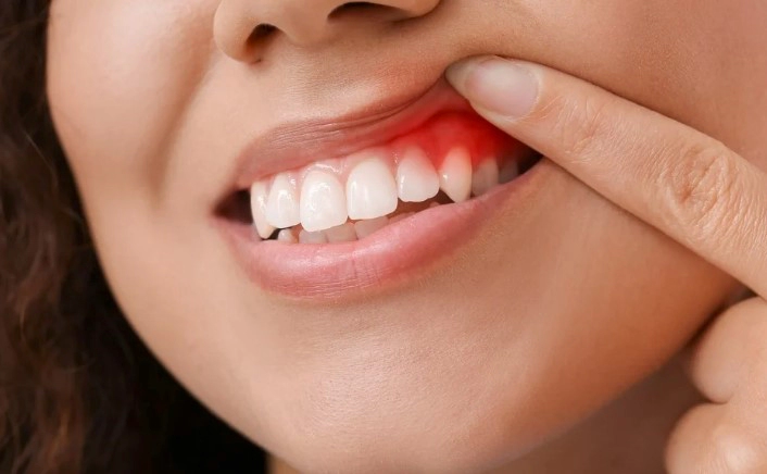 치은염 증상 8가지