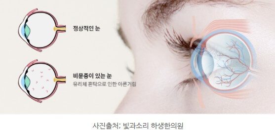 비문증 증상 설명