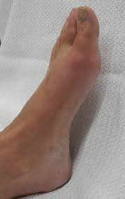 통풍