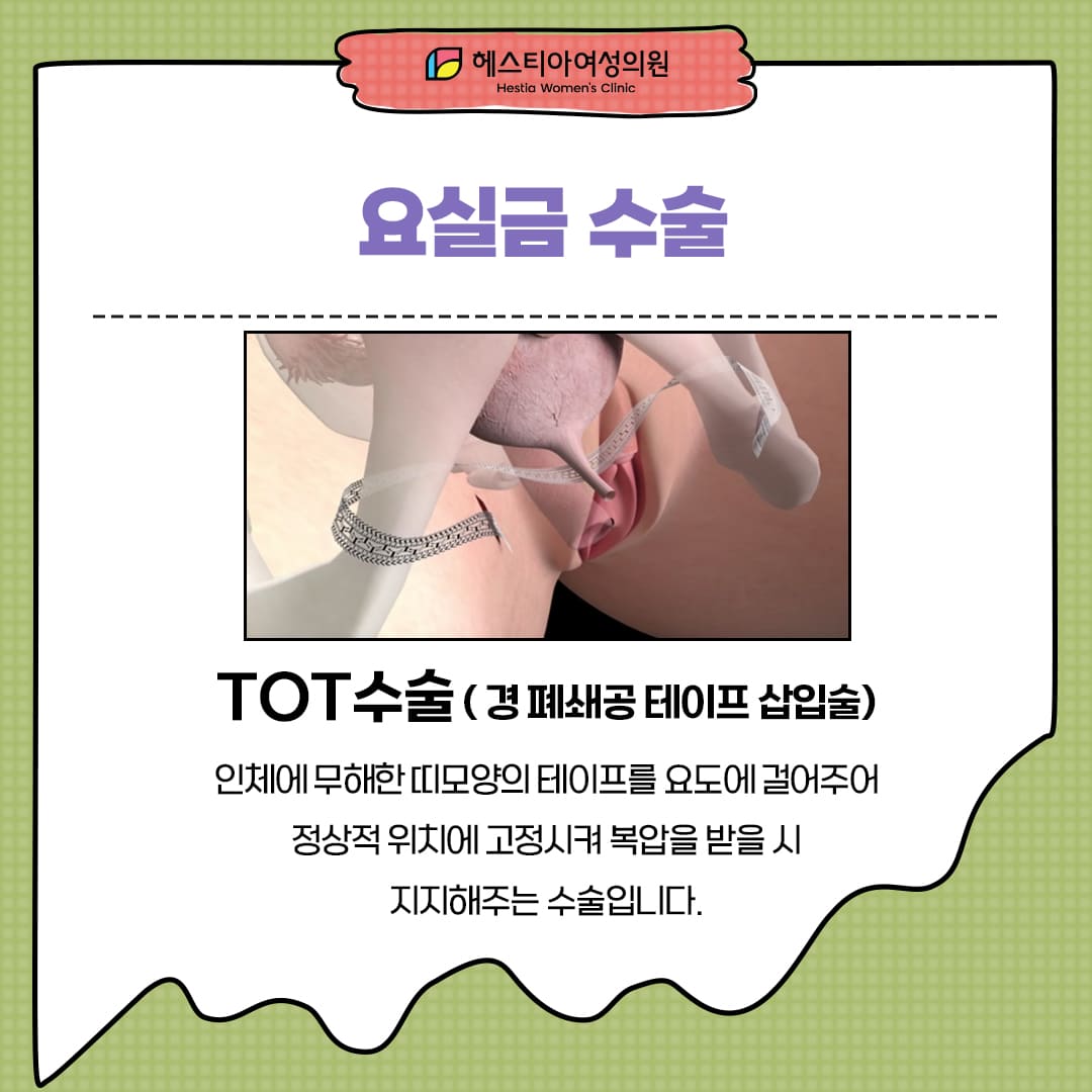 요실금수술
TOT수술
요실금증상
요실금치료방법