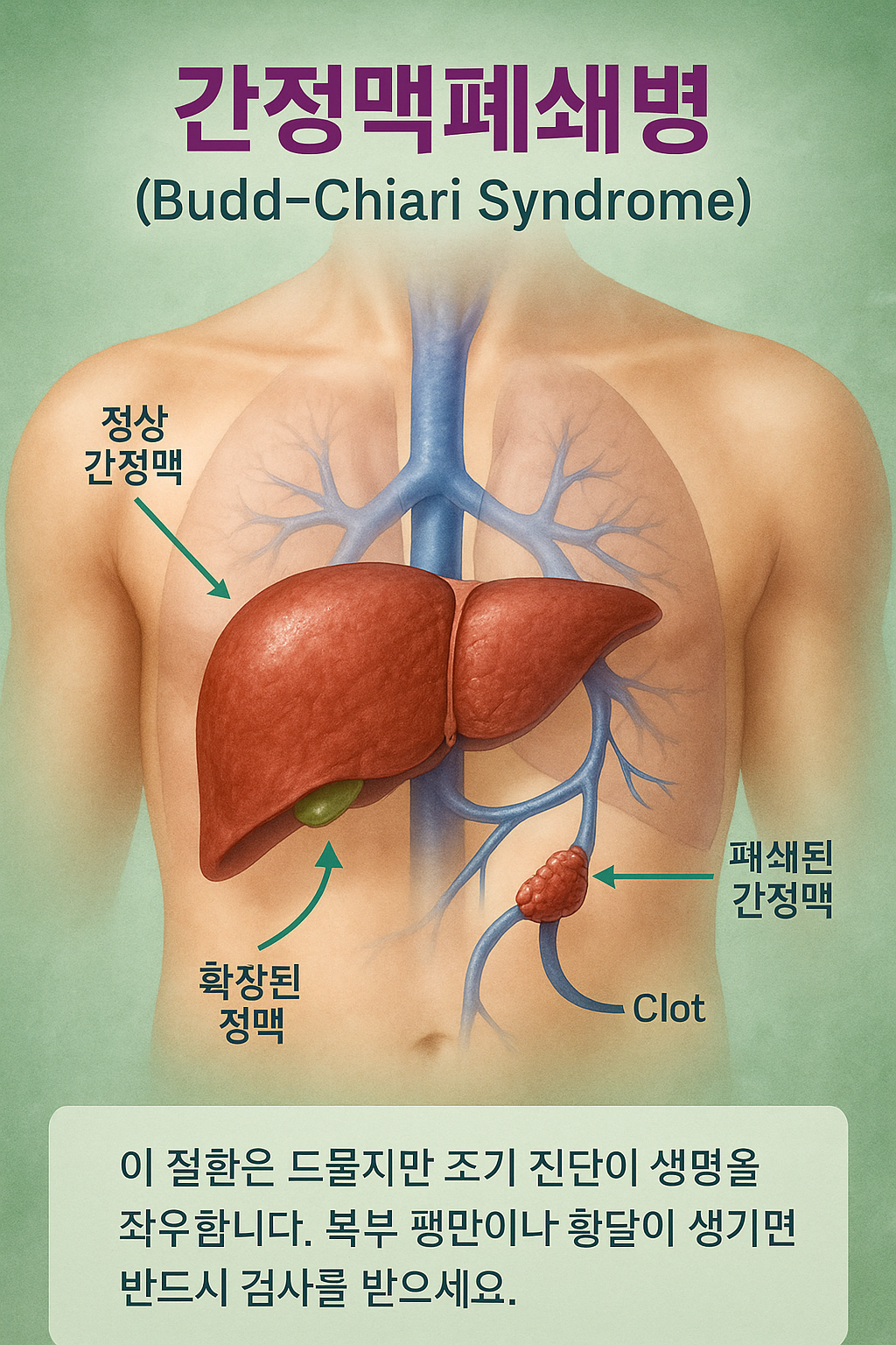 1.간정맥폐쇄병 증상