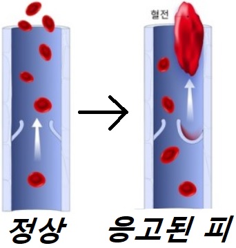 혈전증상