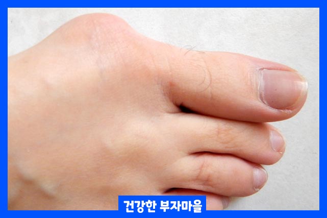 무지외반증(Hallux valgus)이란?