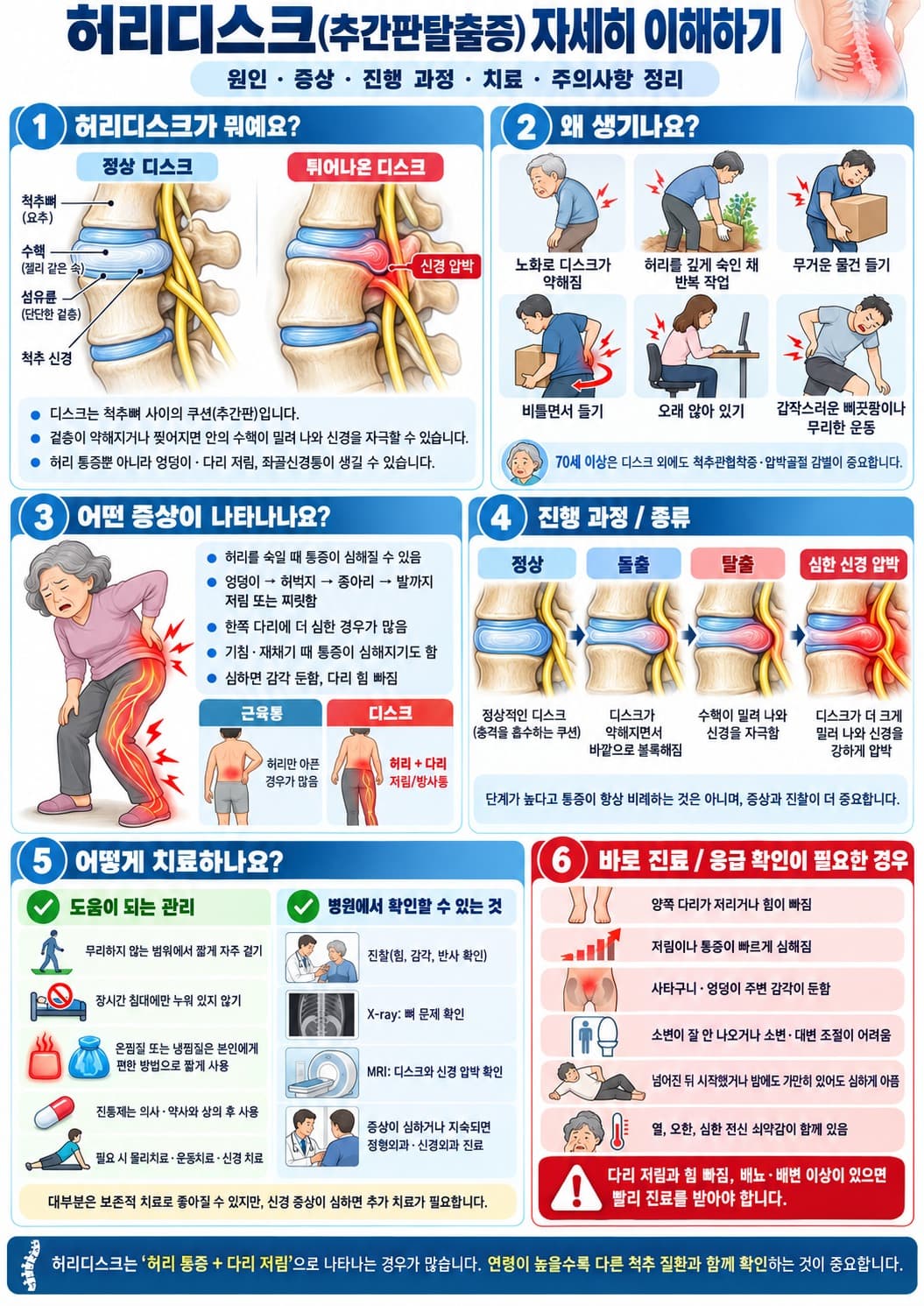 70대 허리디스크 추간판탈출증 원인 증상 진행과정 치료방법 신경압박 설명