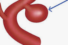 뇌동맥류 초기 증상