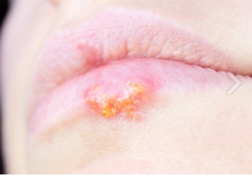 입술에 물집이 생기는 이유