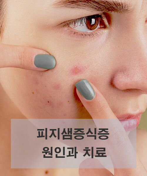 피지샘증식증-짜는-모습