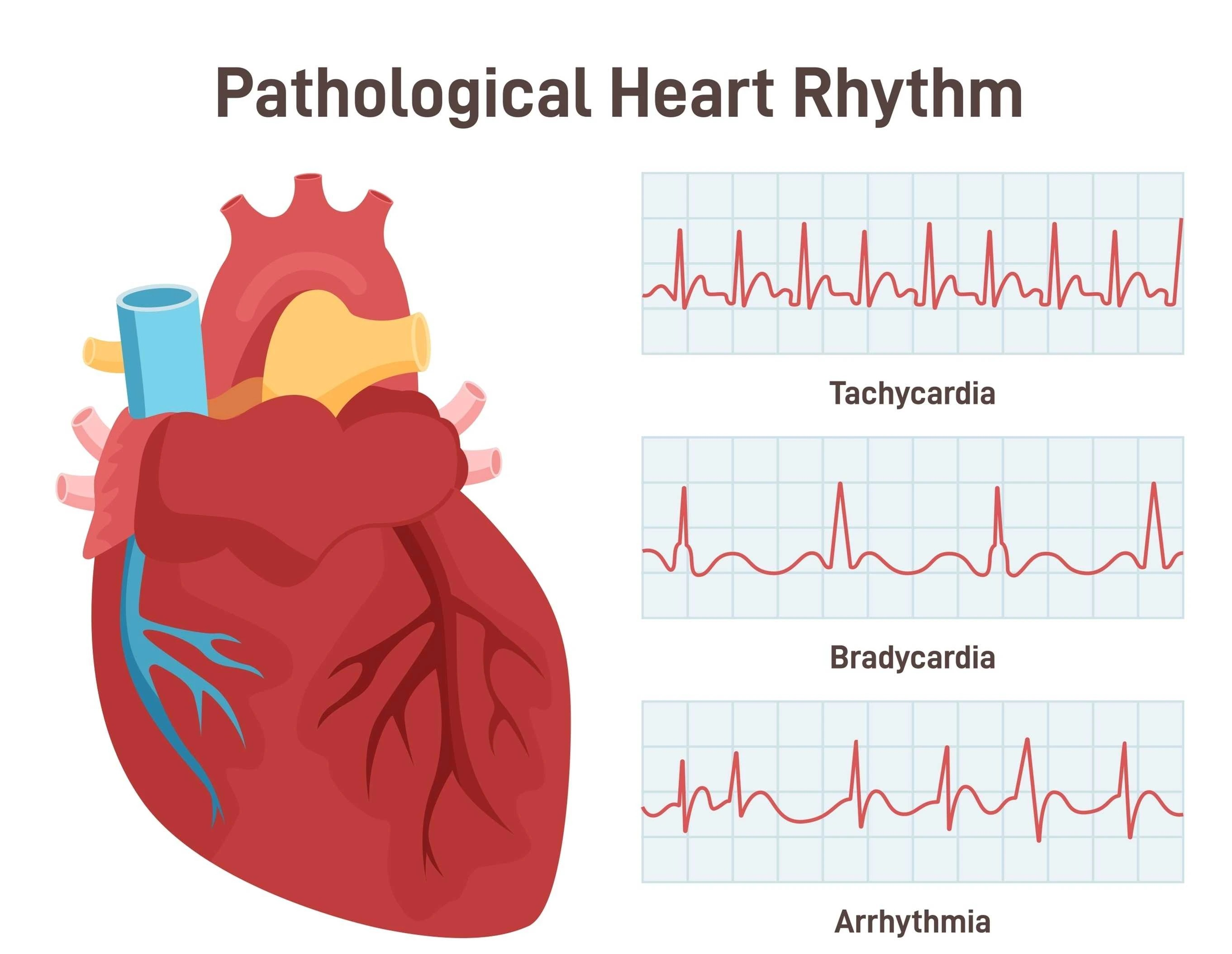 부정맥, 심장의 불규칙한 신호를 이해하다