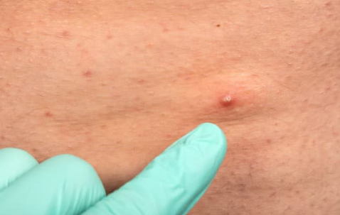 모낭염 원인과 치료방법