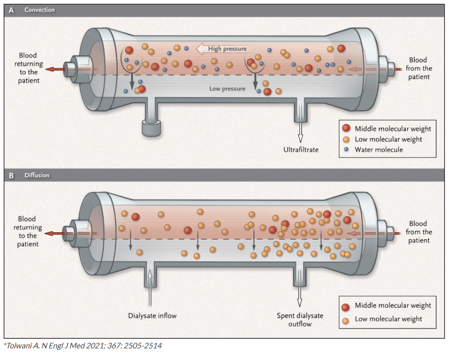 HD(혈액 투석) 및 HDF(혈액 여과 투석)