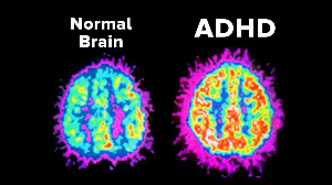 ADHD 증후군 증상 실제 사례