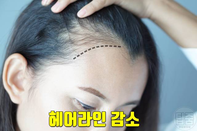 여자 탈모 자가진단 탈모초기증상 헤어라인