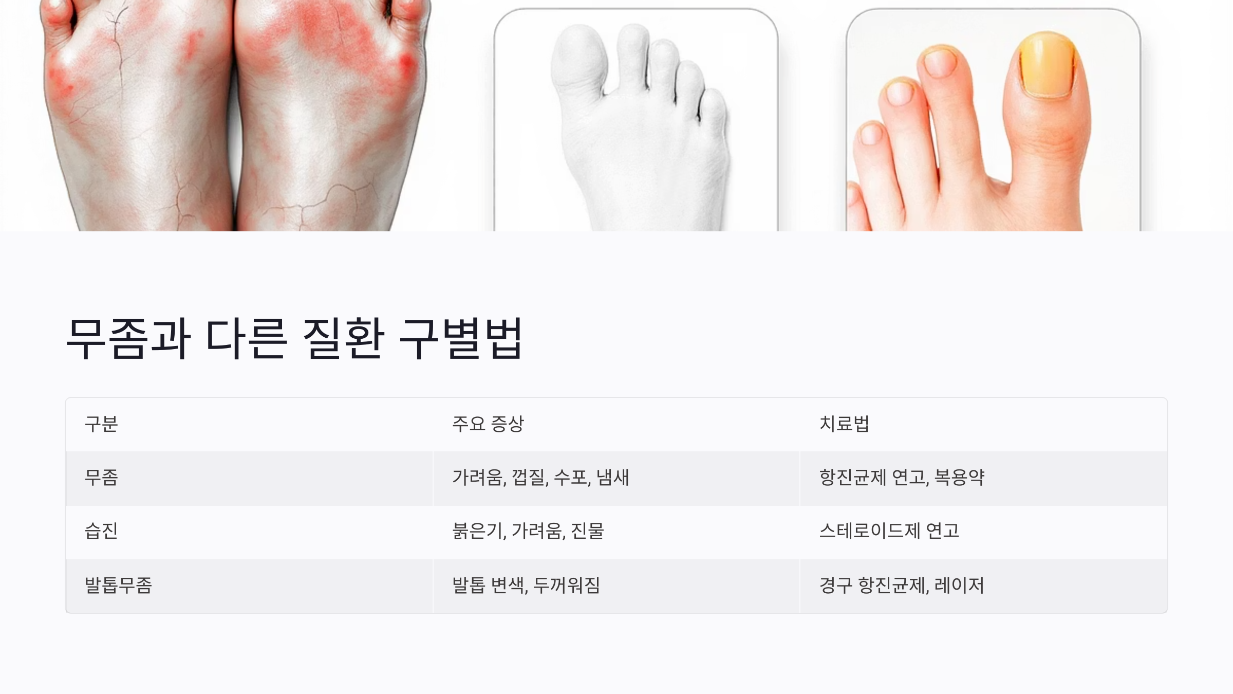 무좀과 습진, 건선 구별법: 헷갈리는 증상 쉽게 비교하기