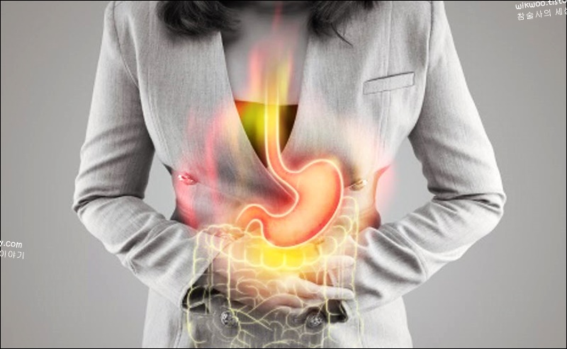 역류성 위염