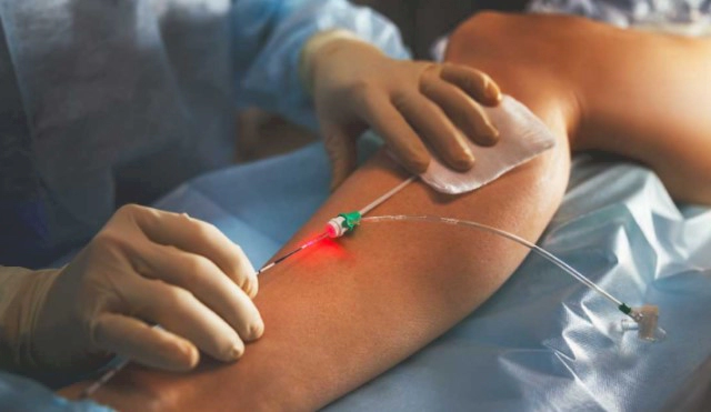 하지정맥류 베나실 치료법