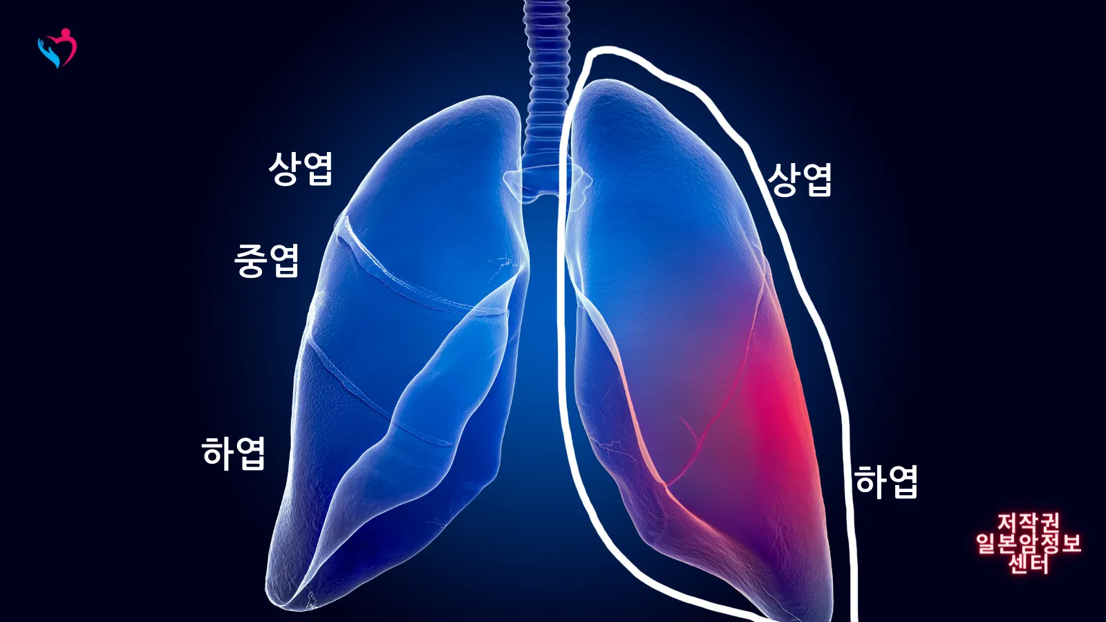 폐암 증상 원인 검사 치료