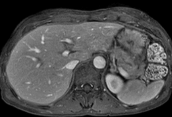 암(癌) 수술 후, 재발/전이 방지를 위한 필수 체크리스트!