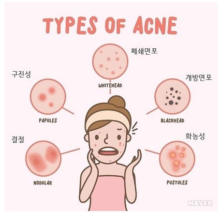 여드름-증상