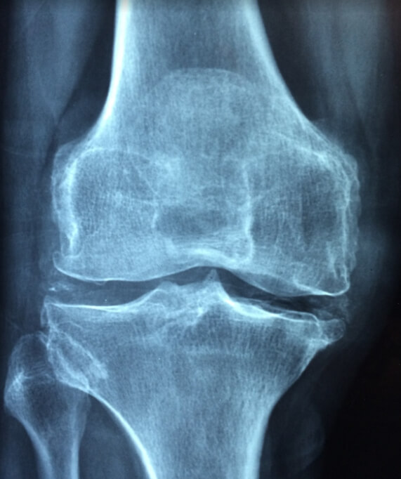 무릎 관절 엑스레이