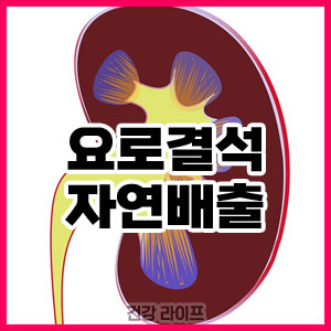 요로결석 자연배출