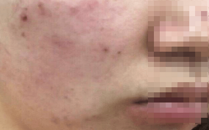 클라리티 레이저 시술 전 얼굴 상태