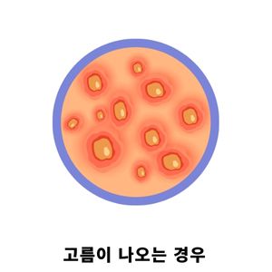 화상 물집 치료방법