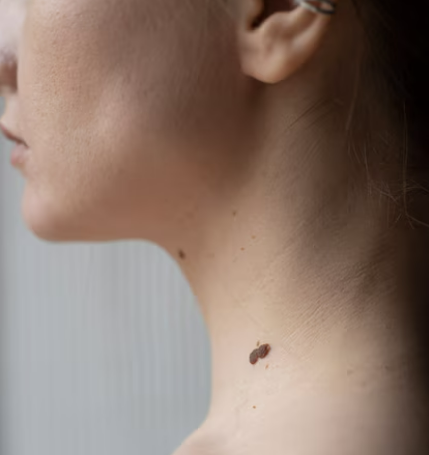 사마귀-목사마귀