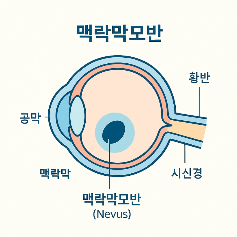 눈 속 맥락막과 맥락막모반 위치를 표시한 인포그래픽