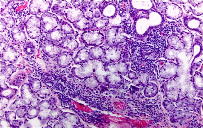 쇼그렌증후군 사진