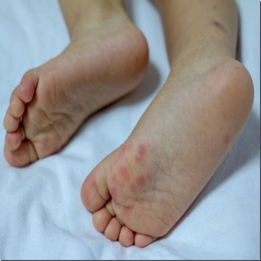 수족구 어른 전염 원인 및 증상과 치료