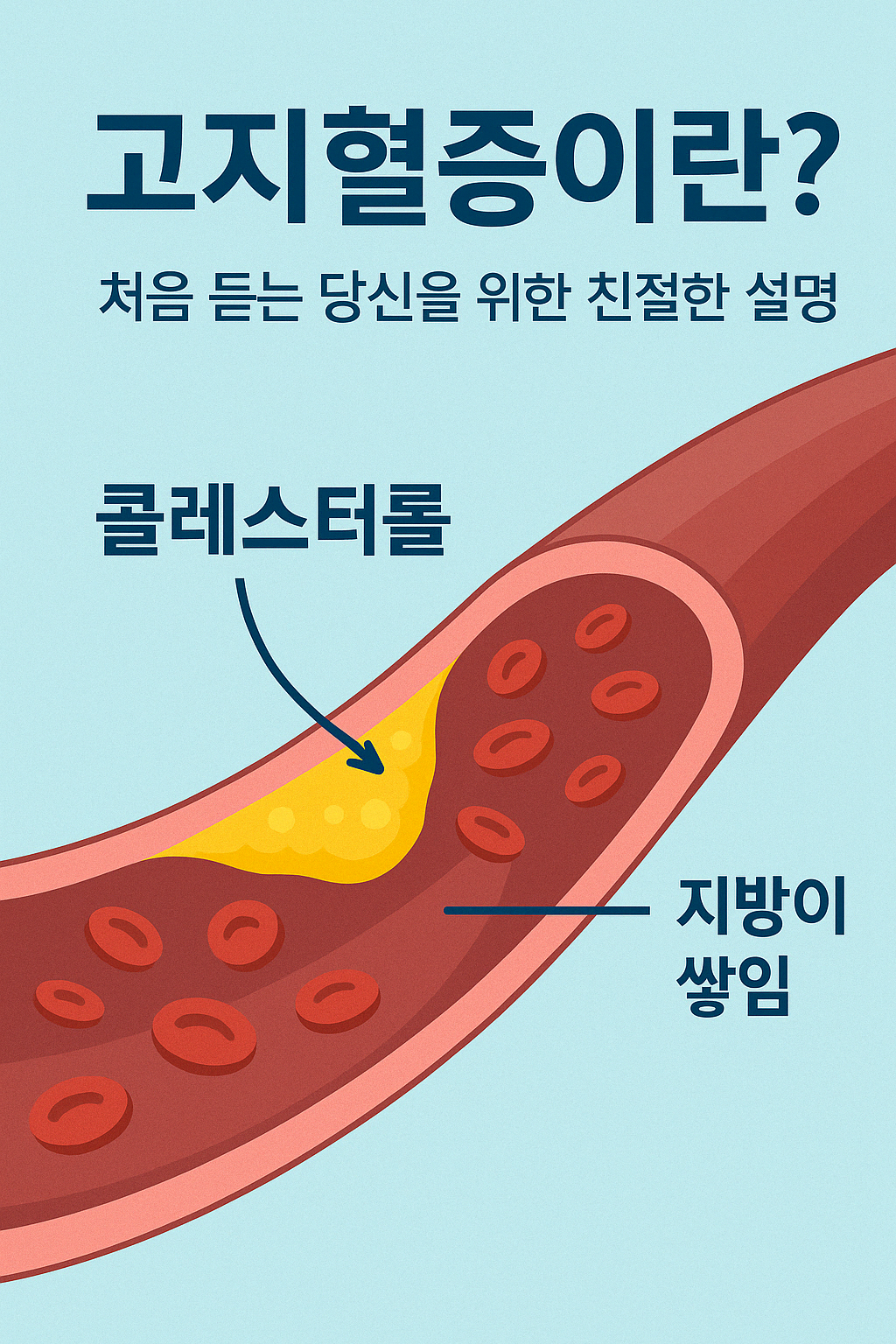 "혈관 내부에 콜레스테롤과 지방이 쌓이는 모습을 보여주는 고지혈증 개념도. 붉은 혈관 단면에 노란색 지방이 축적되어 혈류를 방해하는 모습이 묘사됨."