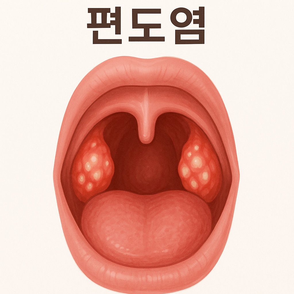 편도염 원인과 증상 치료법